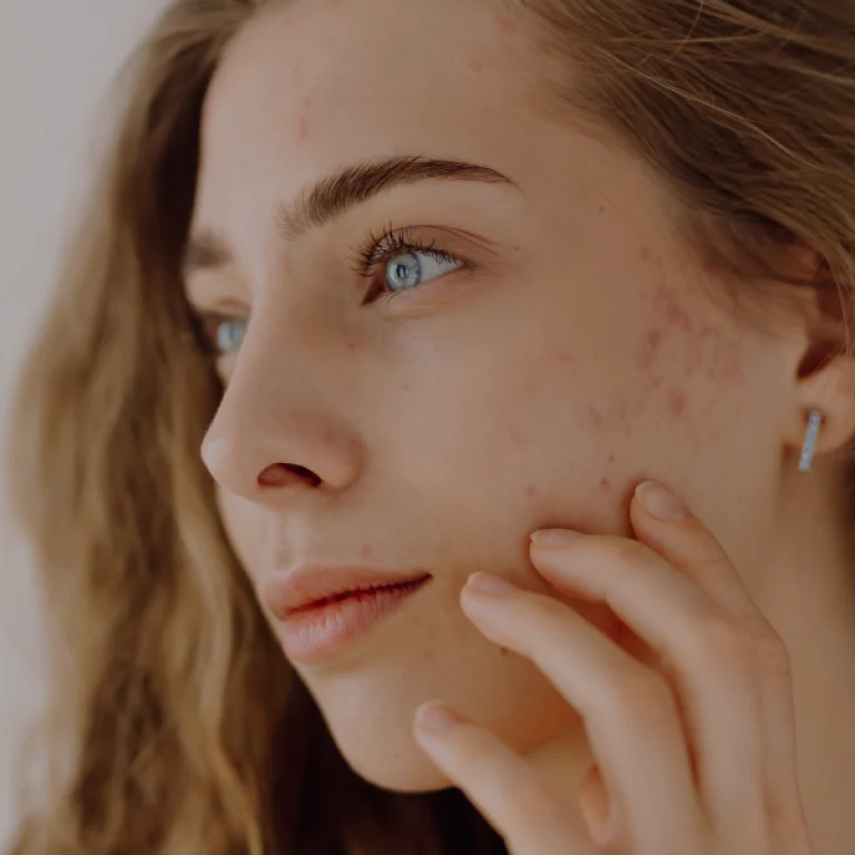 Acne scar treatment 4 times