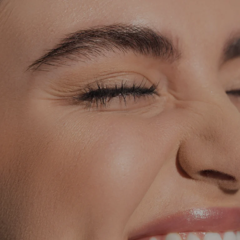 Eye area, crow_s feet