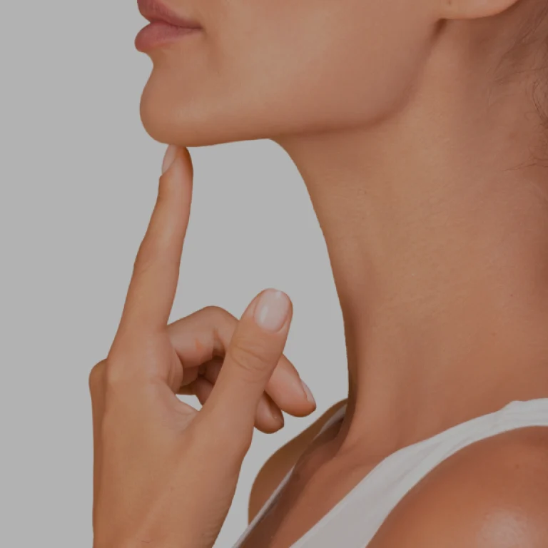 Filling labiomental folds with hyaluronic acid