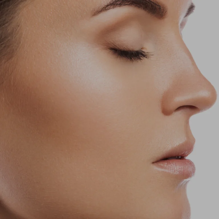 Filling the labiomandibular fold with hyaluronic acid