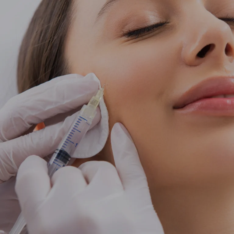 Mid-face lift with hyaluronic acid