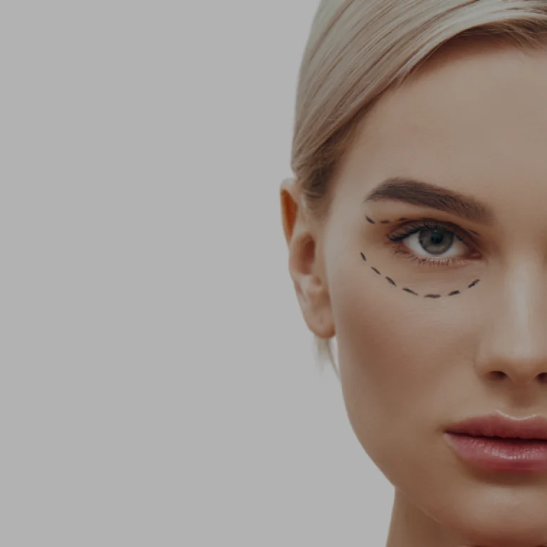 Upper Eyelid Surgery